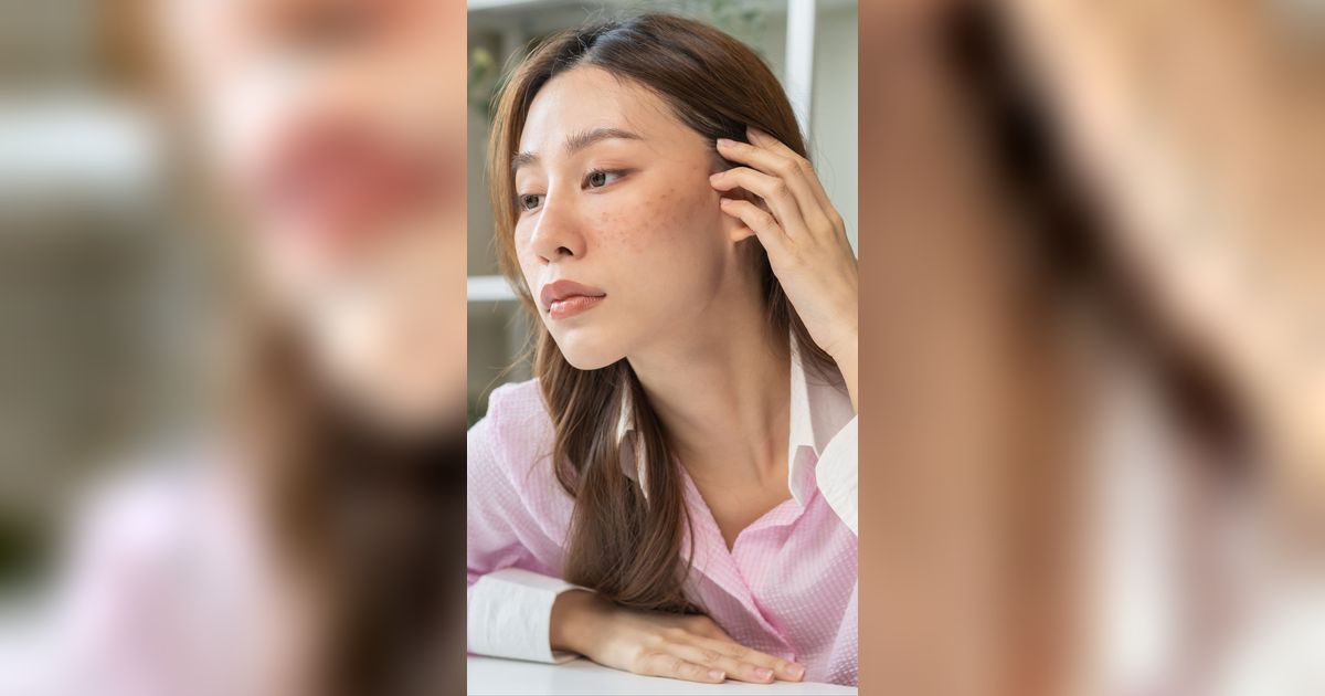 3 Cara Samarkan Flek dengan Skincare, Ada Triknya