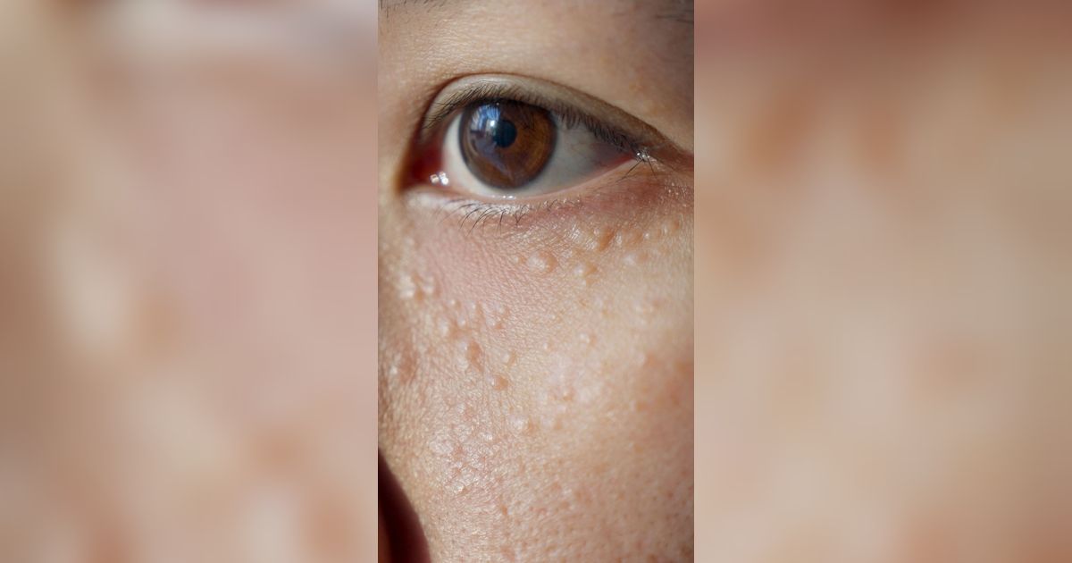 Begini Cara Atasi Milia, Bintik Putih Bertekstur yang Ganggu Penampilan