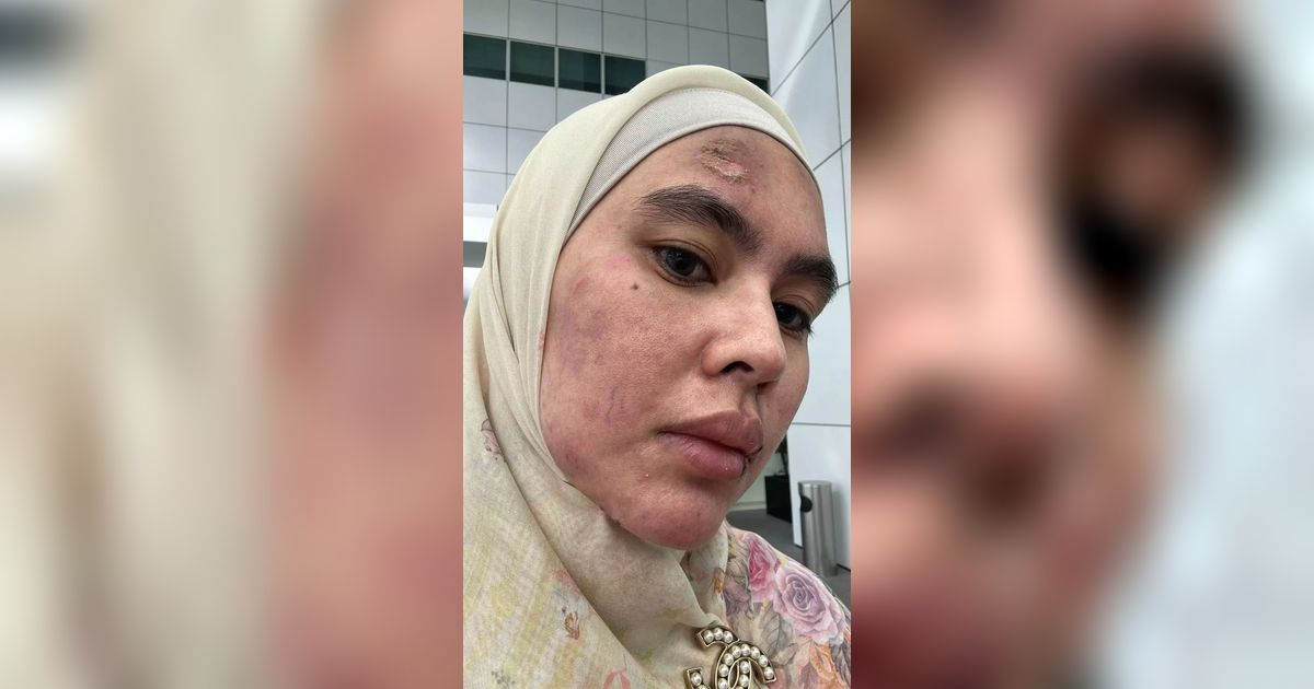 Muka Sempat Melepuh, Potret Terkini Wajah Kartika Putri yang Manglingin