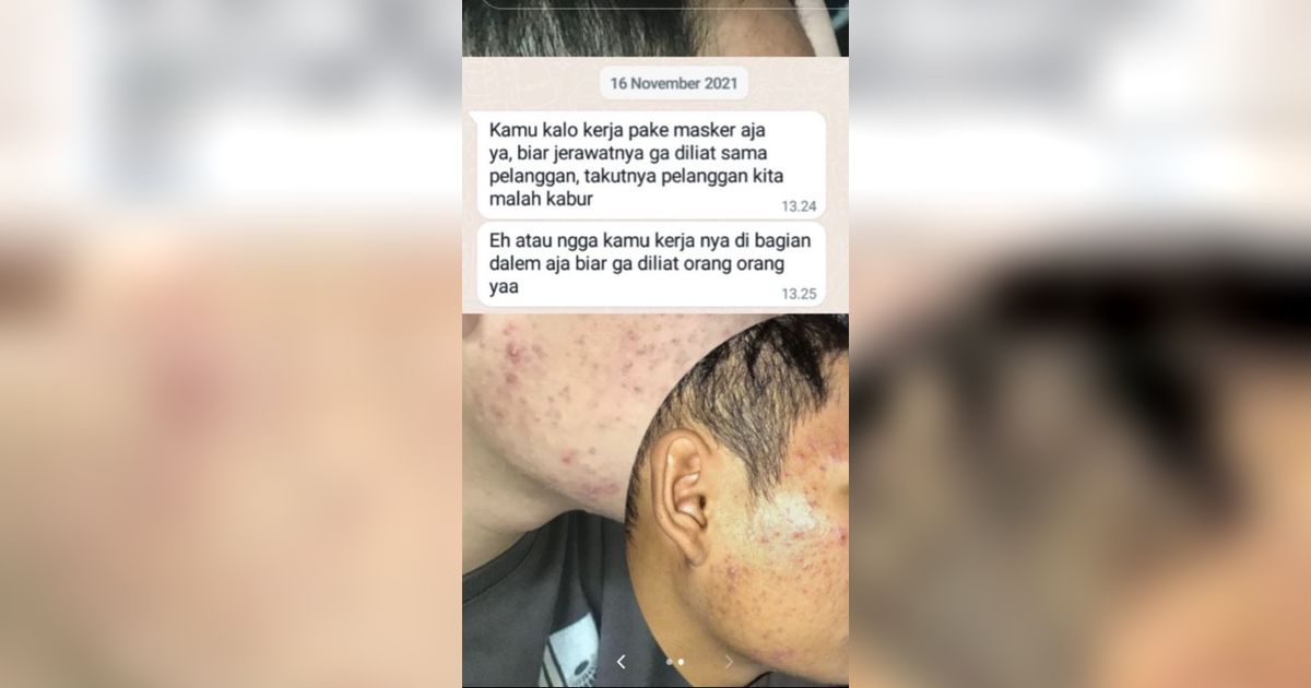 Cerita Karyawan Diminta Pakai Masker Saat Bertemu Pelanggan karena Jerawat Ini Bikin Nyesek