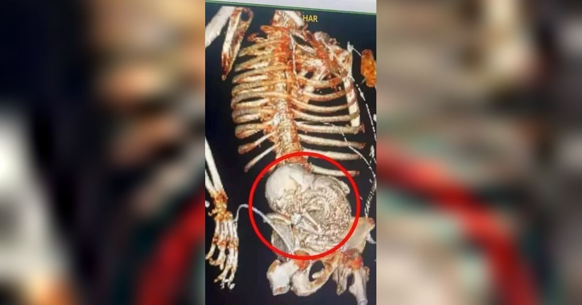 Perut Membesar Dikira Kanker, Nenek 81 Tahun Ternyata `Hamil` Selama 50 Tahun Sampai Janin Membatu