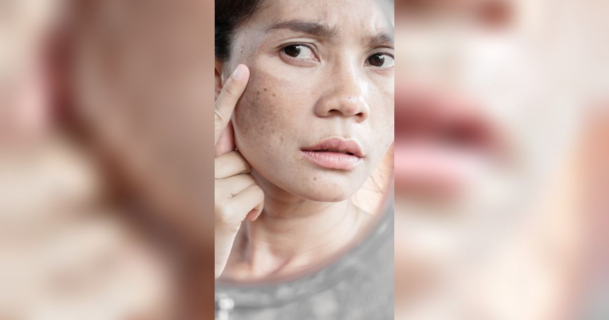 2 Kandungan Skincare yang Ampuh Pudarkan Flek Hitam