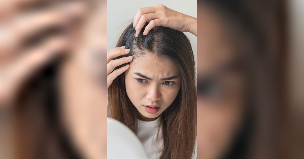 Cara Pakai Sampo Antiketombe yang Benar, Harus Didiamkan Dulu