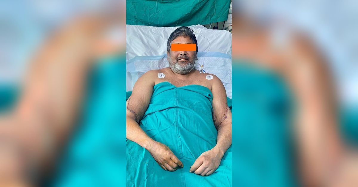 Dokter di India Berhasil Sambung Dua Tangan Seorang Pelukis yang Buntung Selama Tiga Tahun karena Kecelakaan