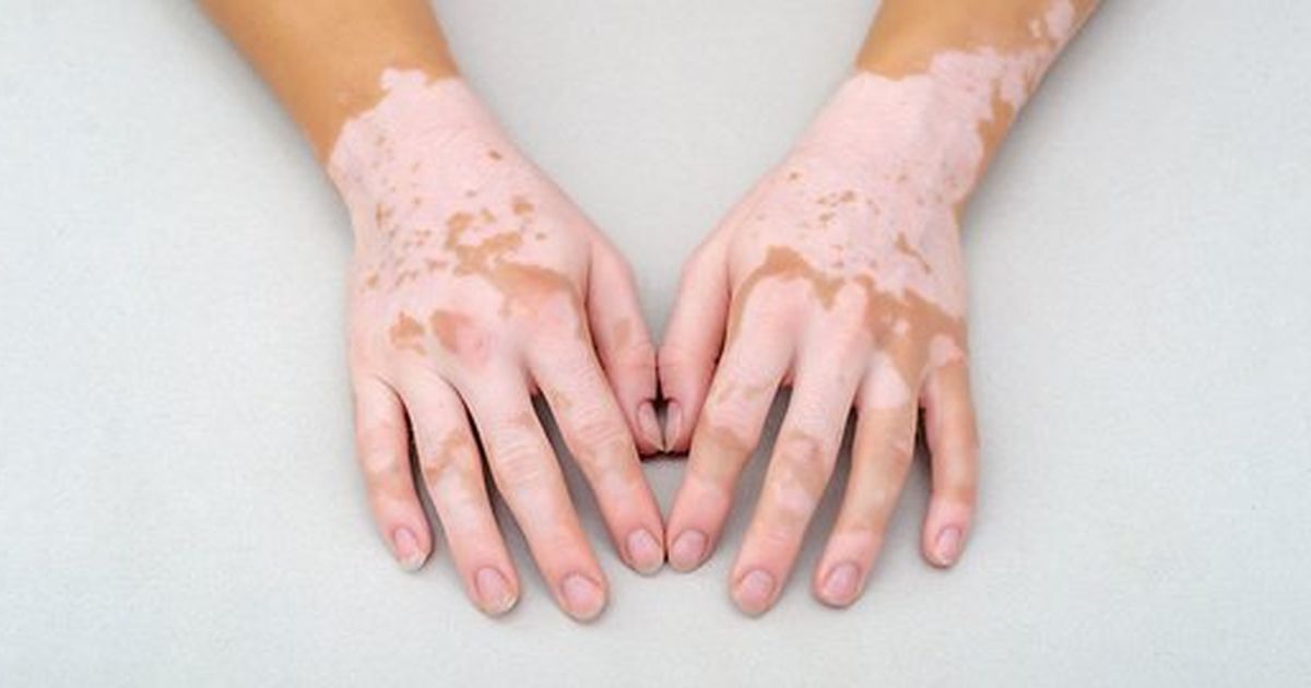 Bacaan Doa Menyembuhkan Vitiligo dan Artinya, Perlu Diamalkan