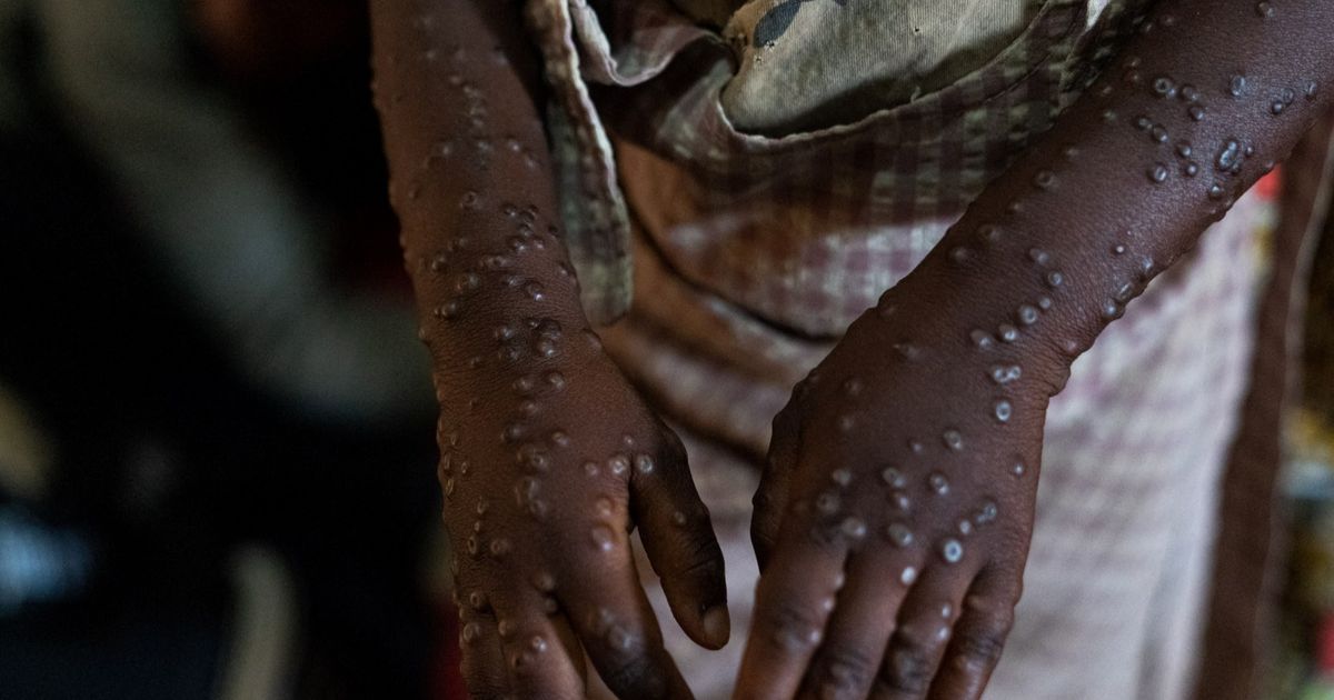 Pembesaran Kelenjar Getah Bening Jadi Ciri Khas Bedakan Mpox dengan Penyakit Lainnya