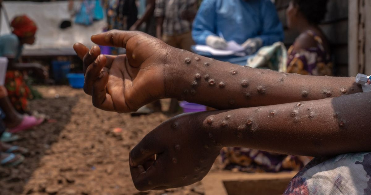 Pasien Mpox Bisa Isolasi Mandiri di Rumah, Ini Syaratnya