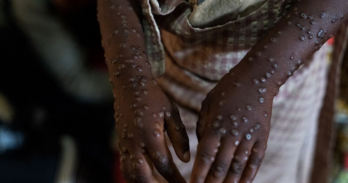 CEK FAKTA: Hoaks Virus Mpox Disebabkan karena Efek Samping Vaksin Covid-19