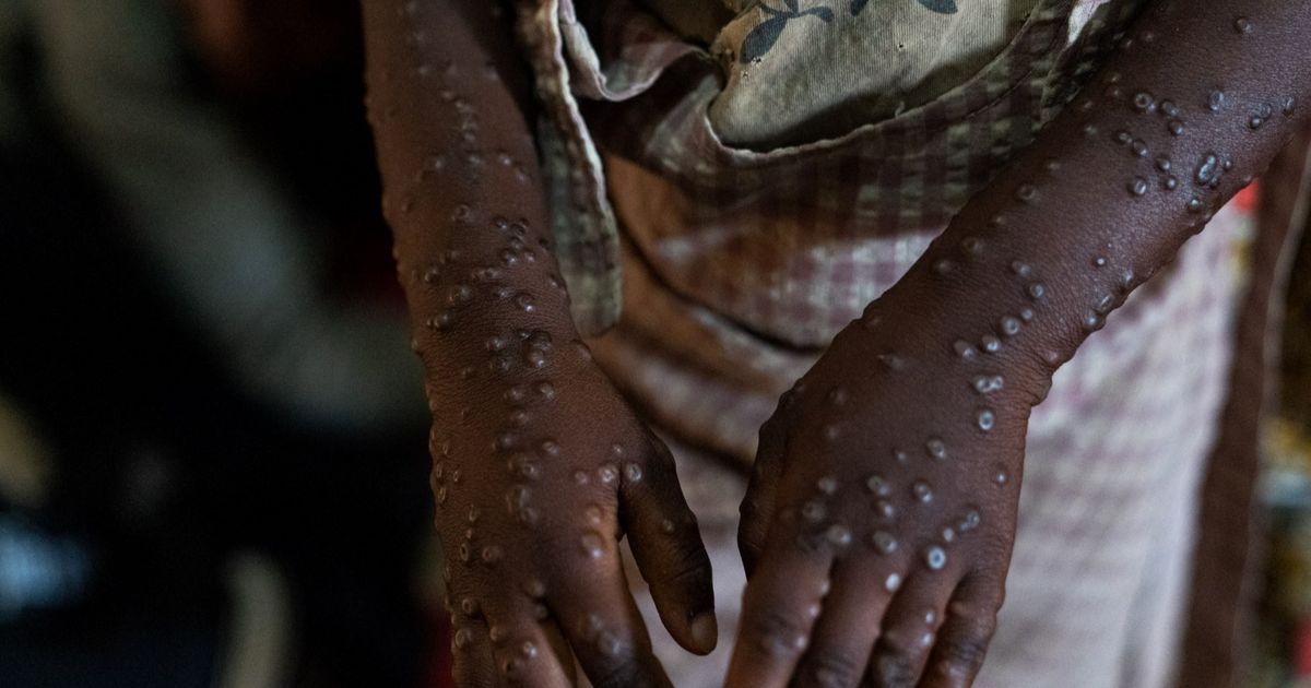 Dokter Sebut Mpox Bisa Picu Penyakit Komplikasi Serius