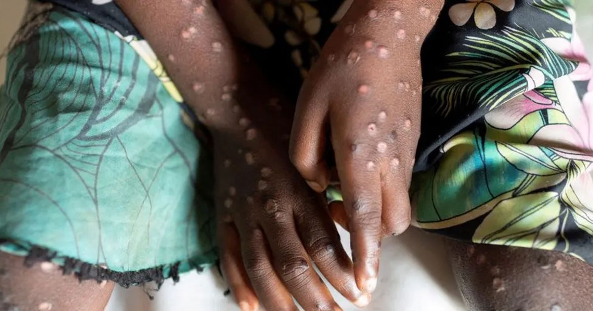 Hasil Tes Lab Keluar, Pasien Suspek Mpox di Bali Ternyata Negatif