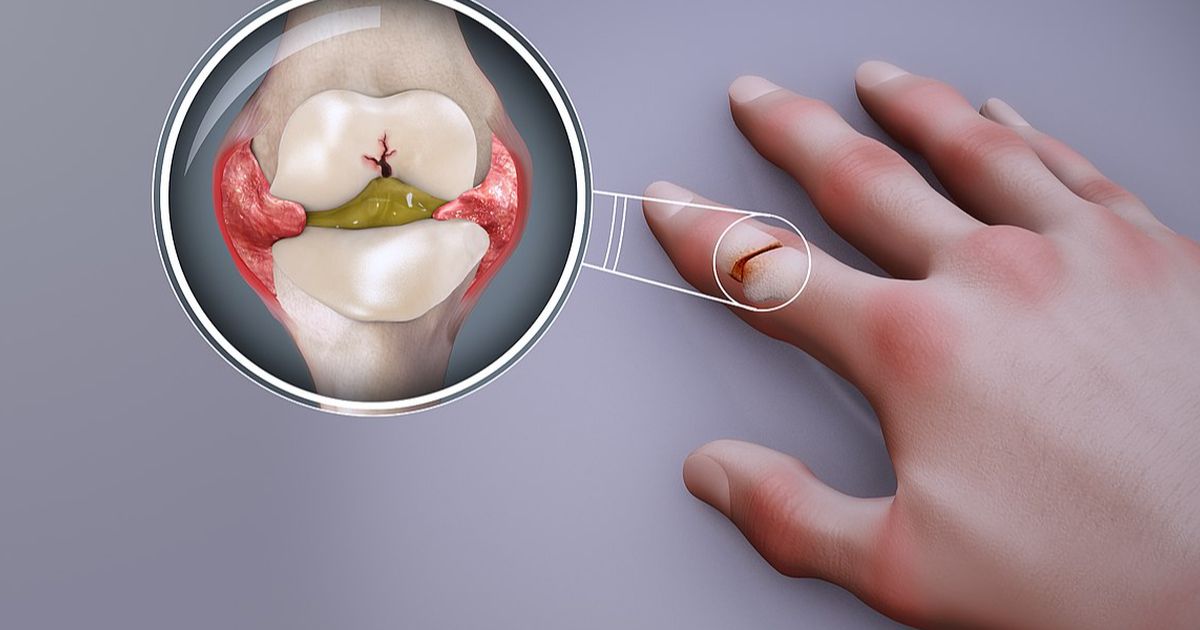 5 Penyebab Rematik Kambuh, Waspadai Makanan yang Memicunya
