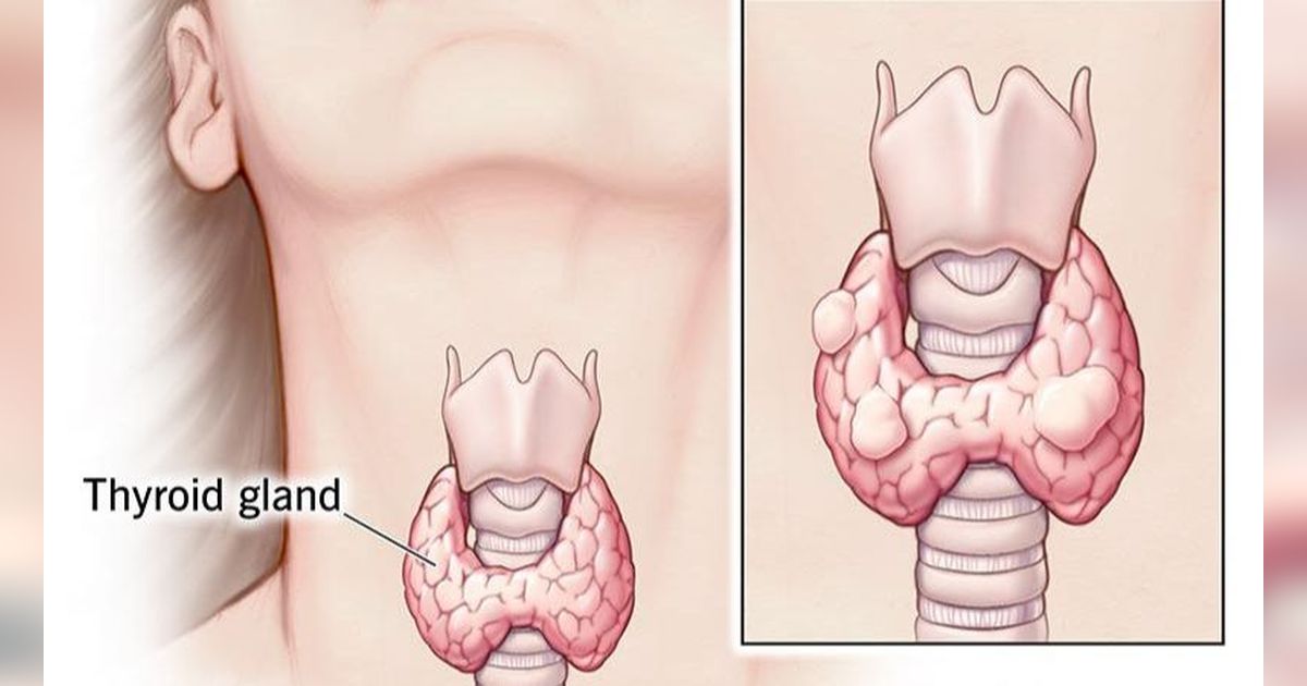 9 Makanan yang Dianjurkan untuk Penderita Hipertiroid, Perlu Diketahui