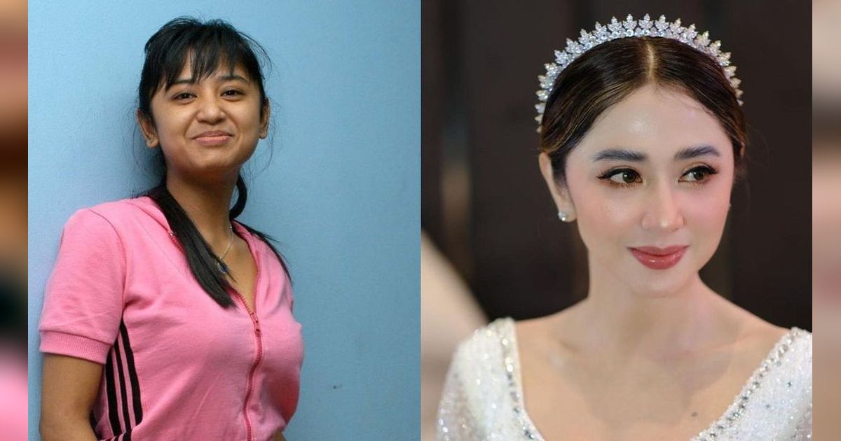 Deretan Artis Lakukan Tanam Benang, Ini Foto Before-Afternya