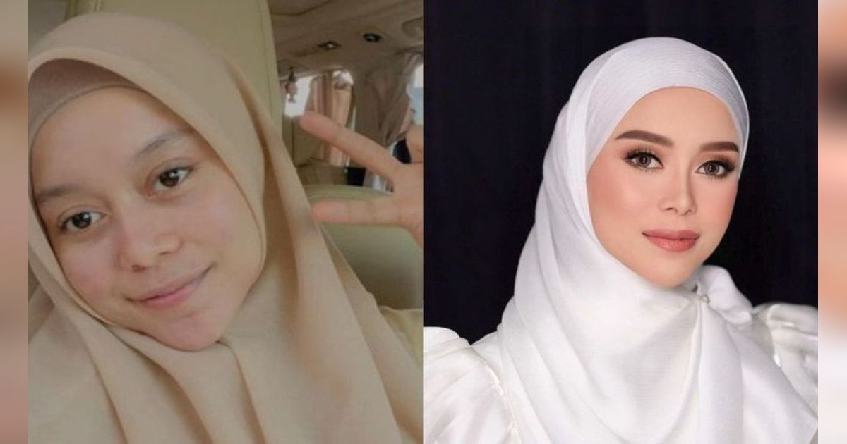 13 Transformasi Artis yang Melakukan Perawatan Dagu Runcing, Sebelum dan Sesudahnya Mengejutkan