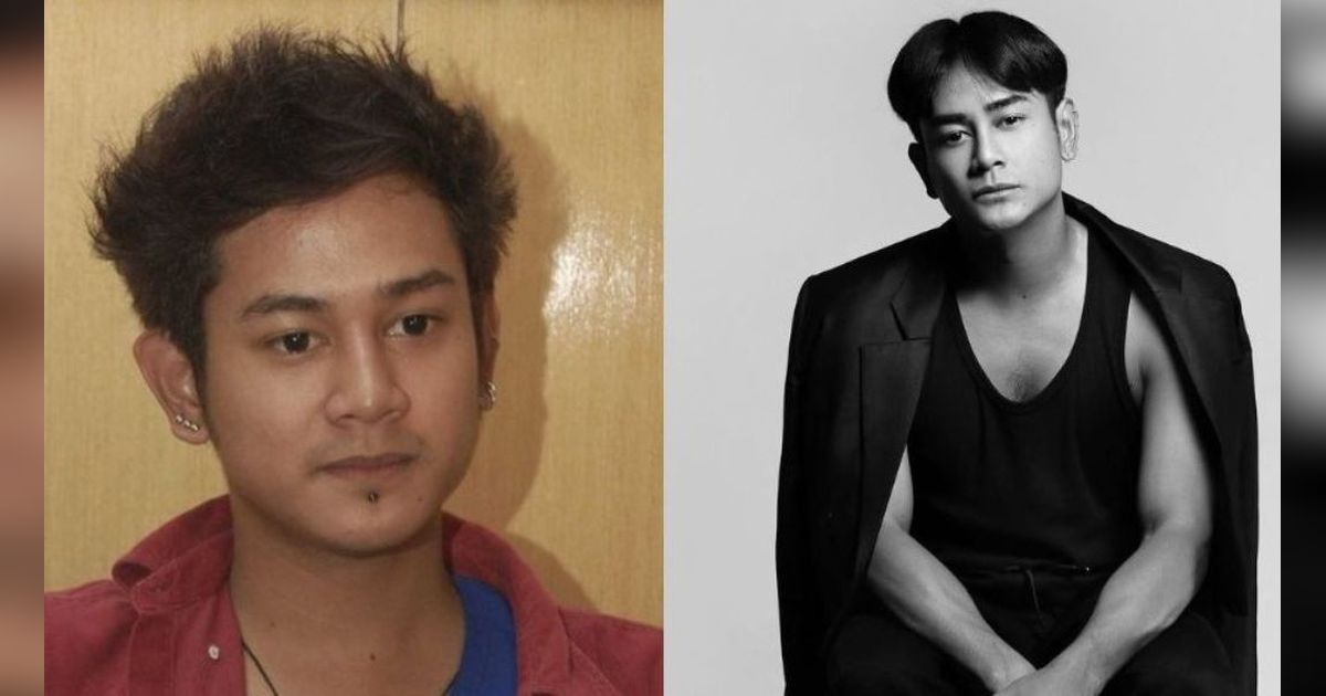 15 Transformasi Artis Sebelum dan Sesudah Suntik Botoks, Nomor 7 Pangling Banget