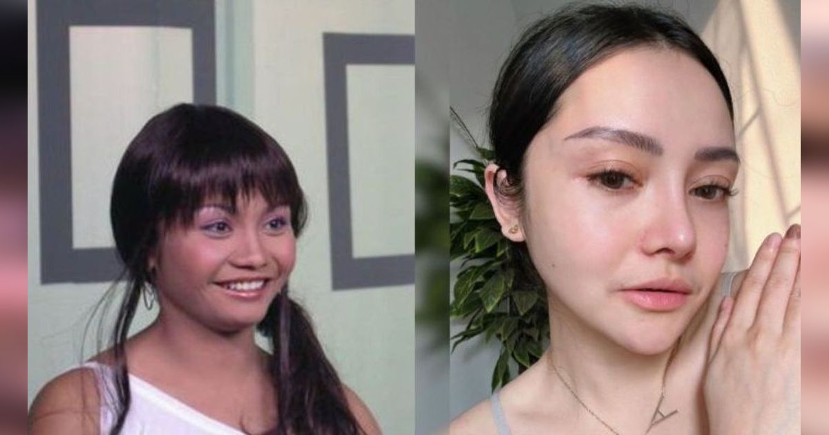 16 Transformasi Artis Sebelum dan Sesudah Operasi Hidung, Ada yang Sampai Beberapa Kali Oplas