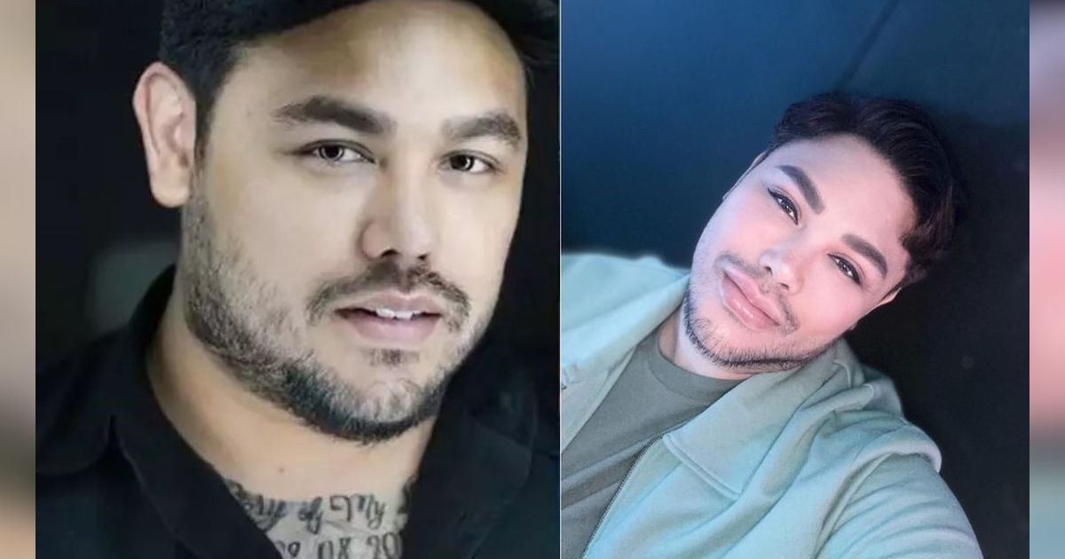 10 Potret Artis Sebelum-Sesudah Filler Bibir, dari Ivan Gunawan sampai Momo Eks Geisha