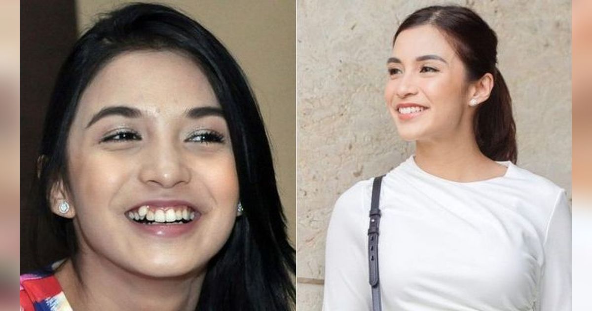 Transformasi 6 Artis Setelah Hilangkan Gigi Gingsul, Ini Potret Sebelum dan Sesudahnya