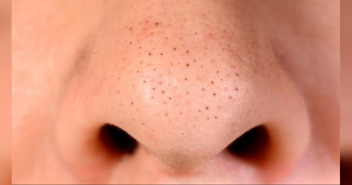 Cara Menghilangkan Komedo di Hidung Secara Ampuh dan Cepat, Cukup Gunakan 3 Bahan Ini!