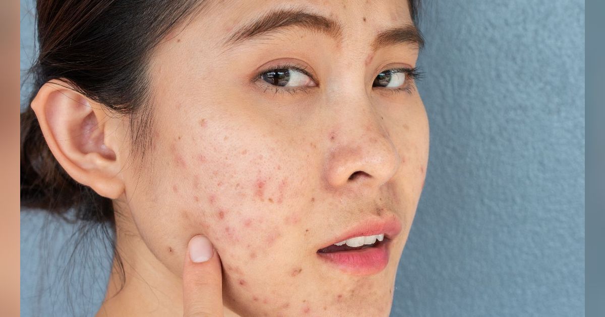 Cara Samarkan Jerawat Bertekstur dan Memerah dengan Trik Makeup