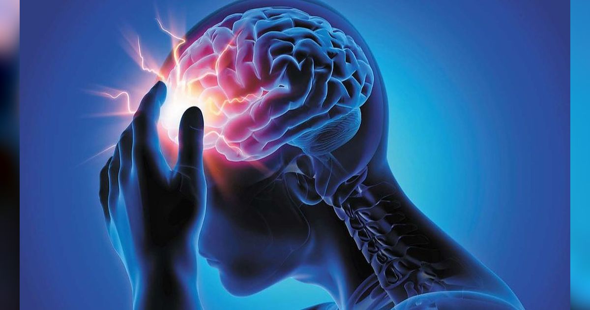 Gejala Aneurisma Otak yang Perlu Diwaspadai, Salah Satunya Sakit Kepala Parah