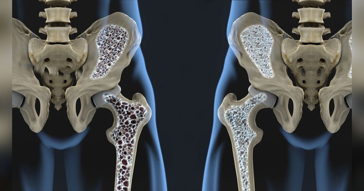 Penyebab Tulang Keropos yang Sering Diabaikan, Begini Cara Mencegahnya