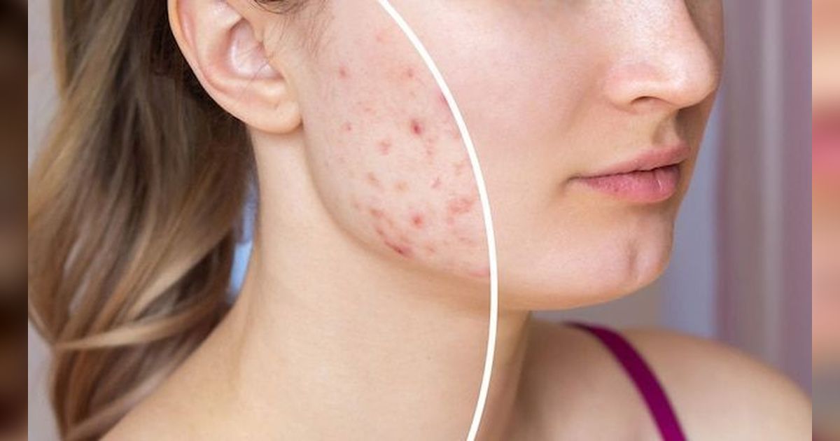 Apakah Boleh Menggunakan Serum Saat Wajah Berjerawat? Ini Cara Memilih Skincare yang Tepat