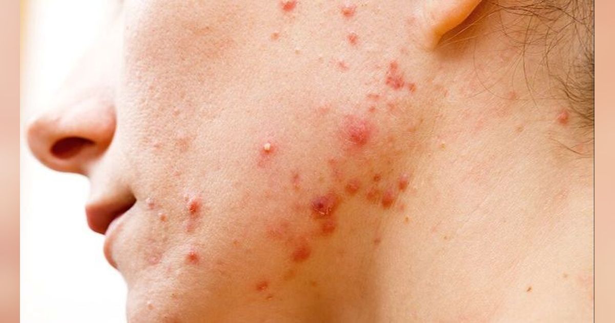 Rekomendasi 10 Serum Terbaik untuk Atasi Jerawat