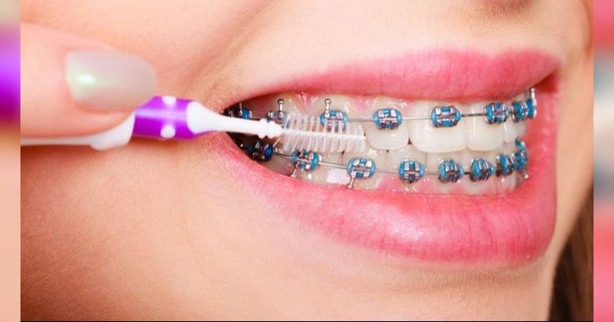 Berbeda dari Biasanya, Ini Cara Memilih Sikat Gigi untuk Pengguna Behel