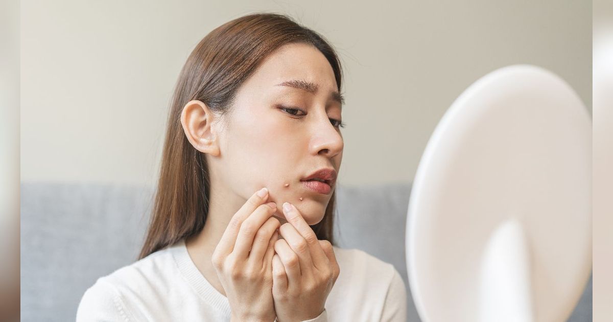 Baking Soda Bisa Kempeskan Jerawat, Ini Cara Aman Memakainya