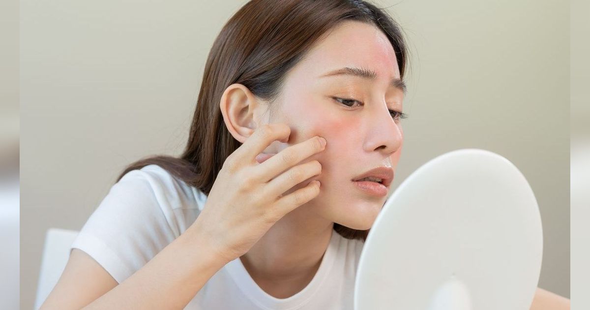 Mitos atau Fakta? Muncul Jerawat di Pipi Kiri Diyakini Pertanda Ada yang Rindu