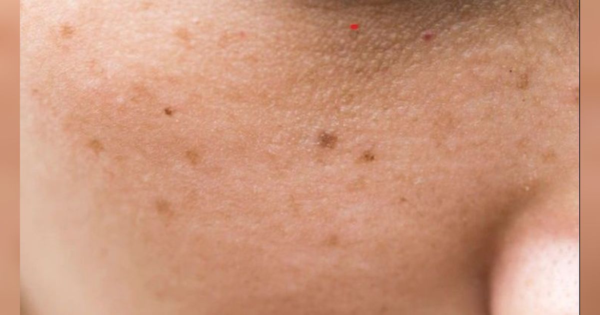 Cara Hilangkan Flek Hitam Tanpa Lemon, Hanya dengan 1 Buah Saja