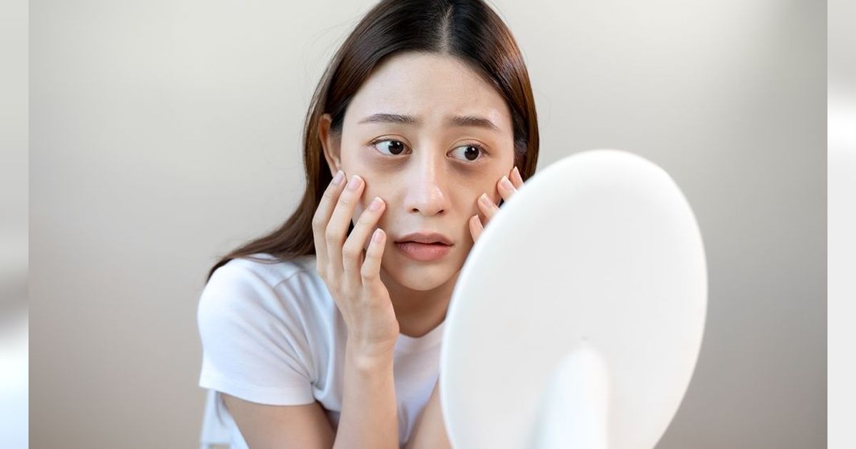 Kekurangan 5 Vitamin Ini Ternyata Bisa Jadi Penyebab Lingkaran Hitam di Sekitar Mata, Cek Kondisimu!