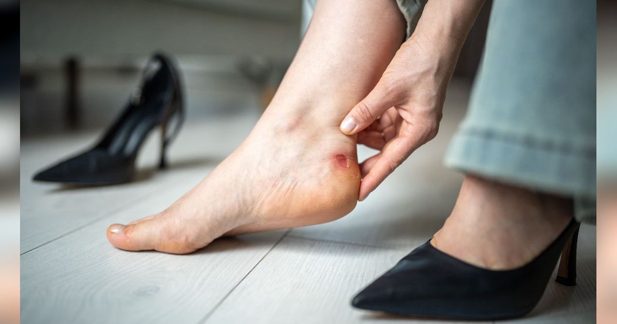 Awalnya Lecet Gegara Pakai Sepatu, Wanita Ini Tak Menyangka Kakinya Harus Diamputasi