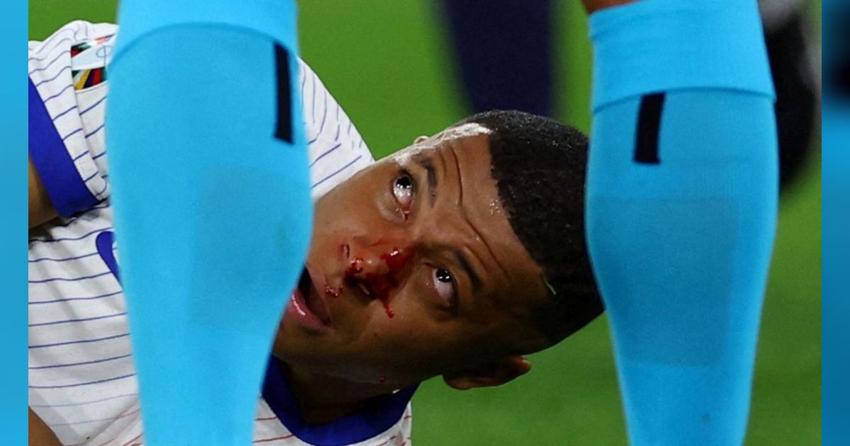 FOTO: Momen Hidung Kylian Mbappe Patah dan Berdarah Saat Laga Prancis Vs Austria