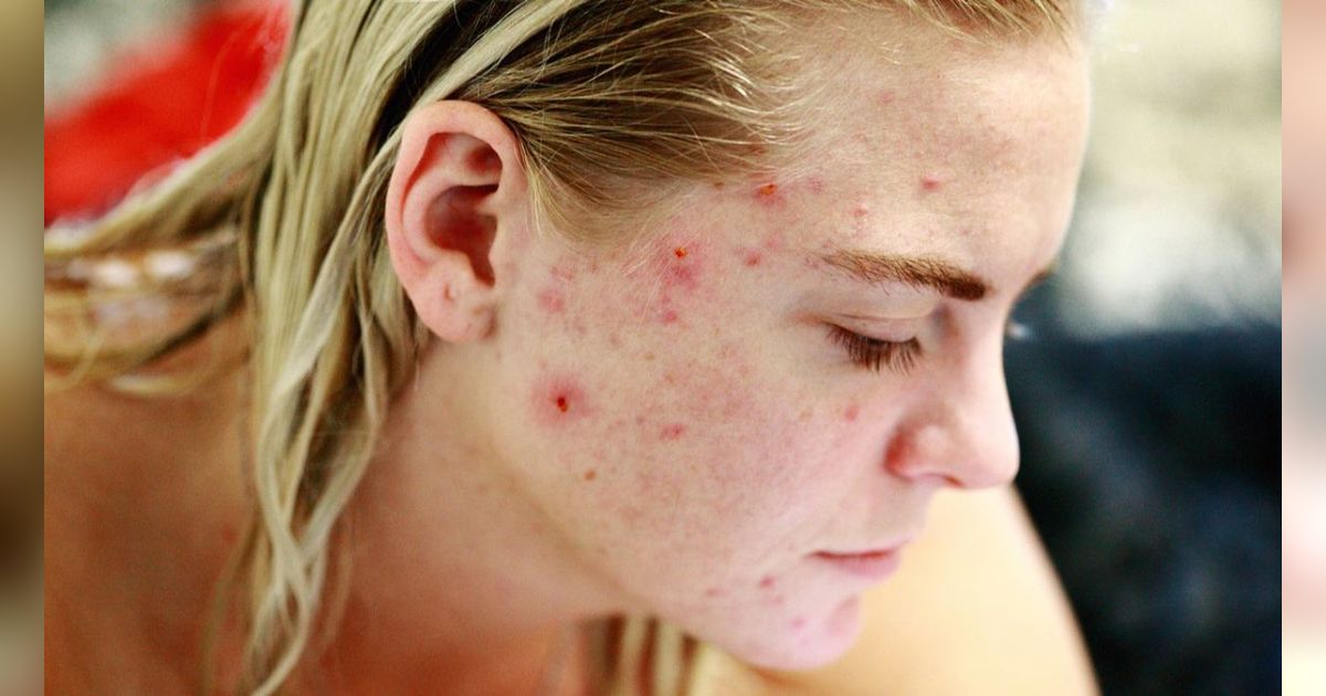 Bahaya Menggunakan Acne Patch Terlalu Lama, Bisa Sebabkan Iritasi