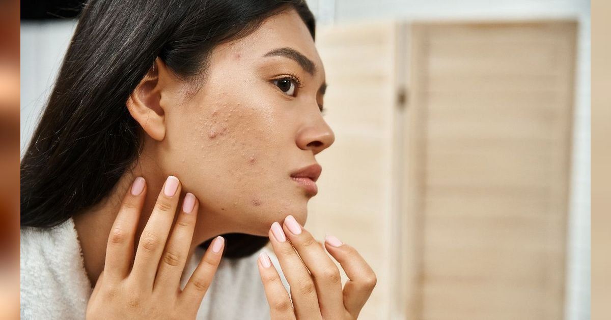 Tak Mempan Pakai Skincare, Coba 3 Prosedur  Atasi Bopeng  Rekomen Dokter Kulit