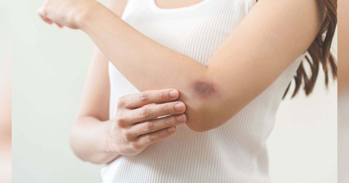 Tubuh Sering Tiba-tiba Memar? Bisa Jadi Karena Kurang Vitamin Ini
