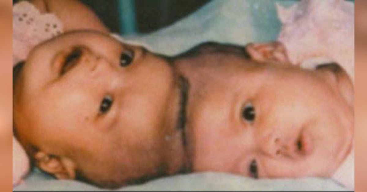 Potret Sosok Yuliana Yuliani, Bayi Kembar Siam Pertama yang Sukses Jalani Operasi Tahun 1987, Kini Jadi Dokter serta Ahli Nutrisi