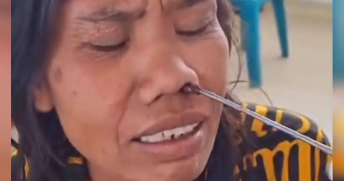 Mengeluh Sakit Hidung 2 Minggu, Pas Periksa Ternyata Benda Asing Hidup di Dalamnya