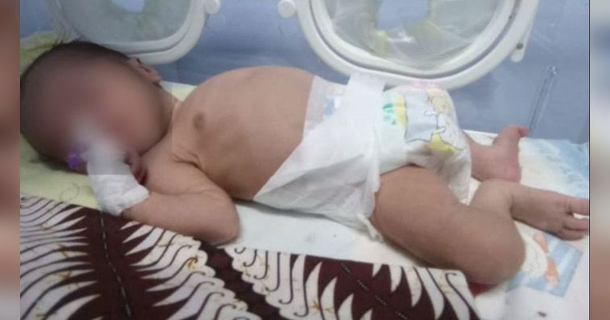 Kisah Pilu Bayi Baru Lahir Ditinggal Kabur Ayah, Sel Tubuhnya Digerogoti Bakteri Ganas Harus Dirawat di ICU