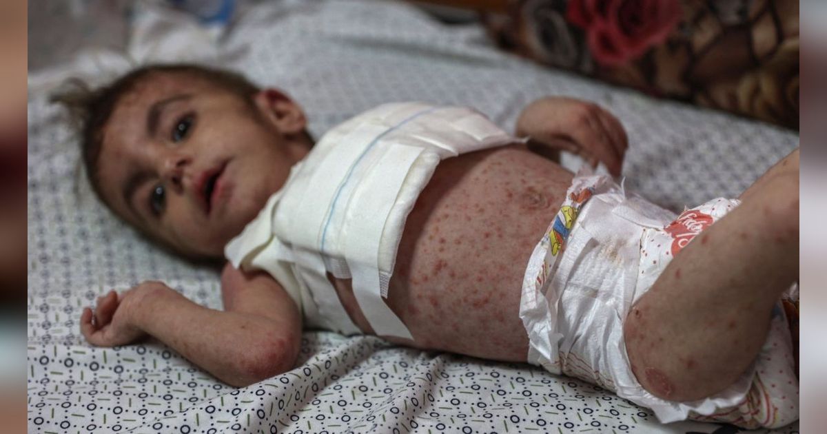 FOTO: Nestapa Anak-Anak Palestina Terpapar Penyakit Kulit Berbahaya karena Krisis Air Bersih di Jalur Gaza