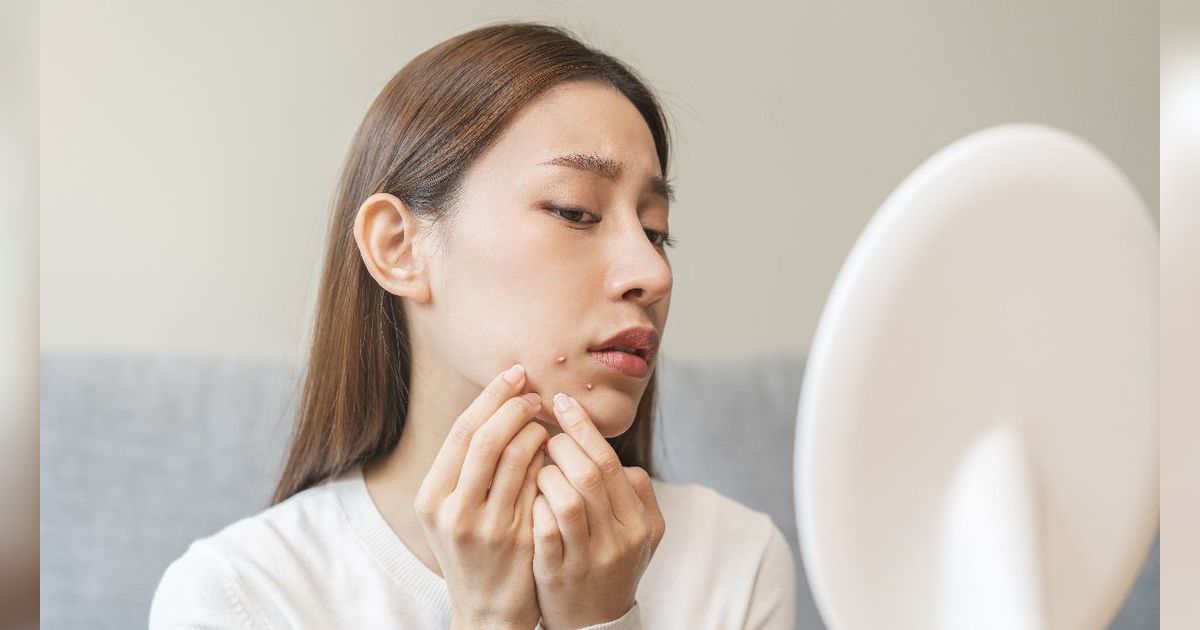 Cara Pakai Concealer untuk Samarkan Jerawat, Wajah Jadi Tampak Mulus