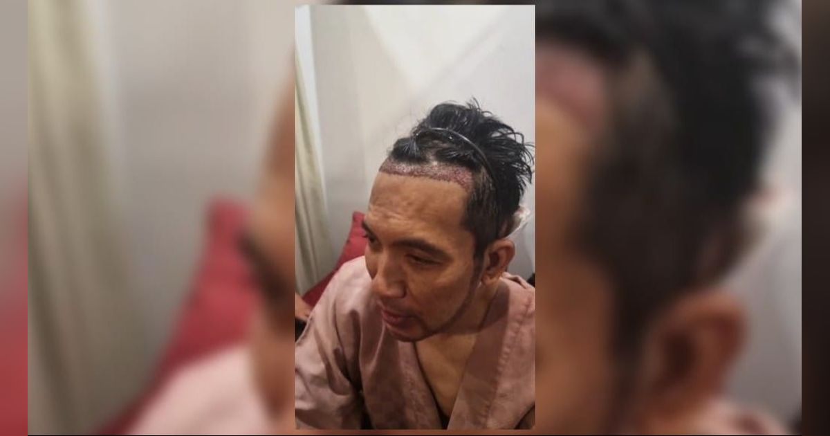 Deretan Artis Tanah Air Jalani Transplantasi Rambut, Terbaru Ada Desta yang Penampilannya Bikin Pangling