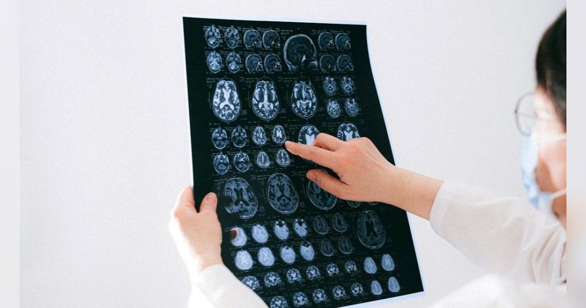Apa Itu Aneurisme Otak? Kenali Kondisinya dari Gejala Awal yang Khas di Mata