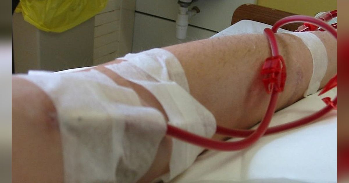 Bagaimana Cuci Darah atau Hemodialisis Bisa Memperpanjang Hidup Seseorang?