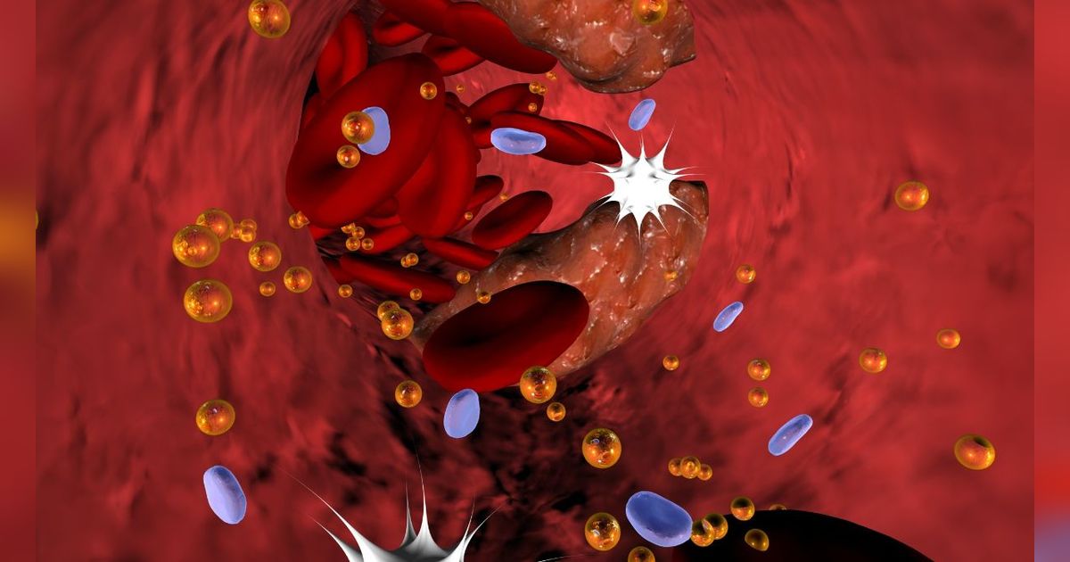7 Penyebab Penyempitan Pembuluh Darah, Begini Cara Mengatasinya