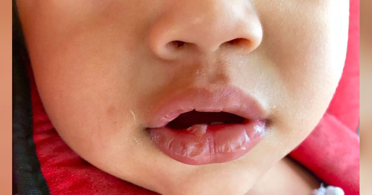 Mengenal Lip Blister Pada Bayi yang Sering Terjadi Saat Awal Masa Menyusui