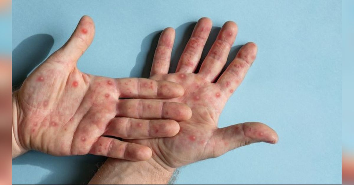 Monkeypox Masuk Indonesia, 4.450 Vaksin Disiapkan