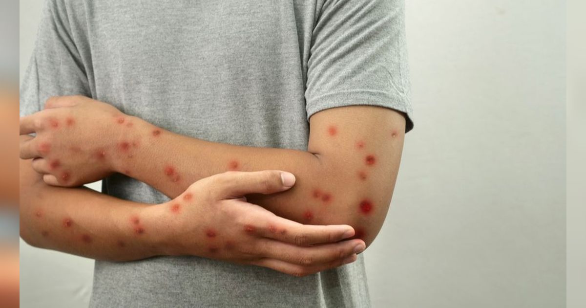 Gejala Monkey Pox Lebih Ringan dari Cacar tapi Bisa Berakibat Fatal